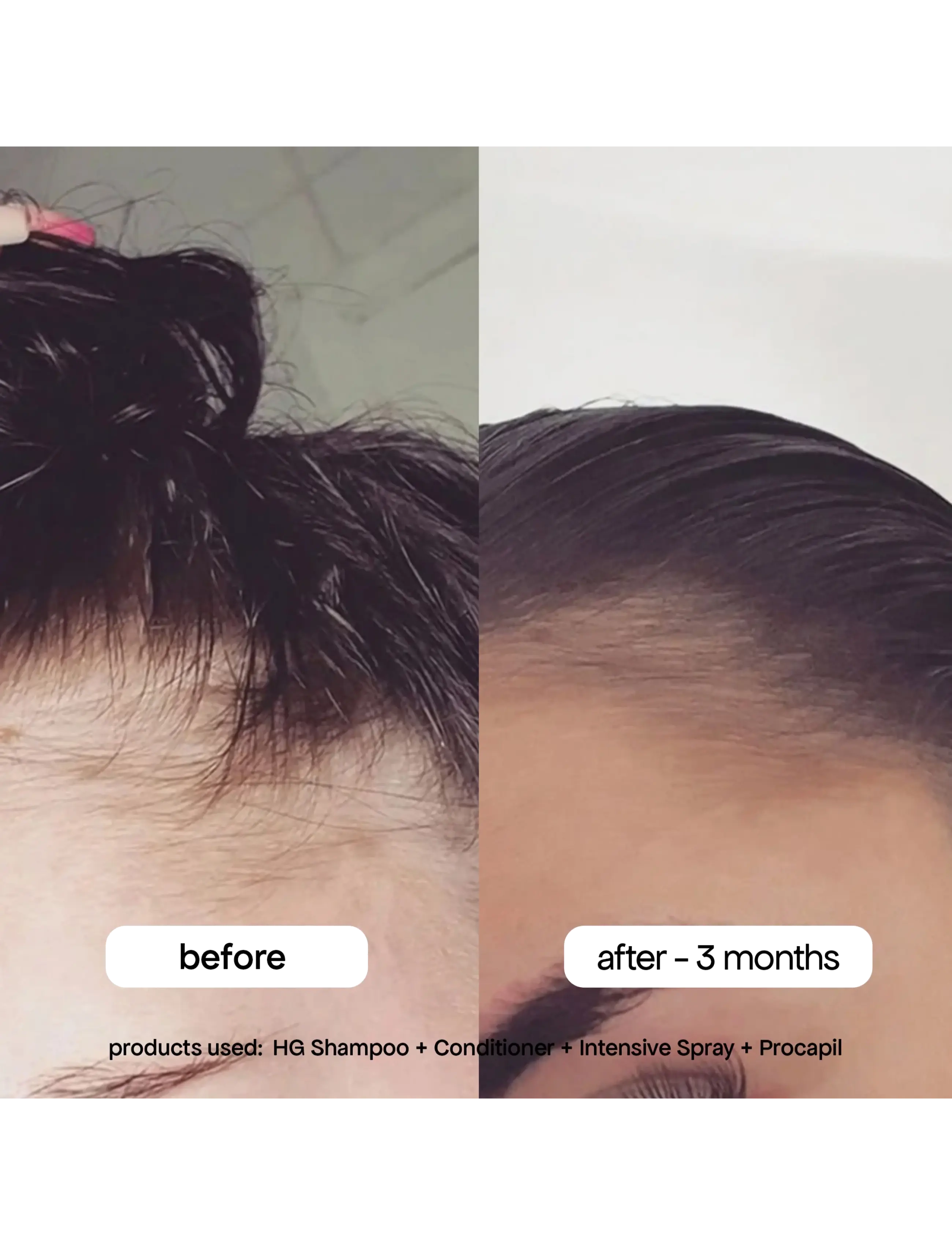 Bondi Boost Hg Anti-Thinning Procapil Scalp Tonic behandling dam – bild 6