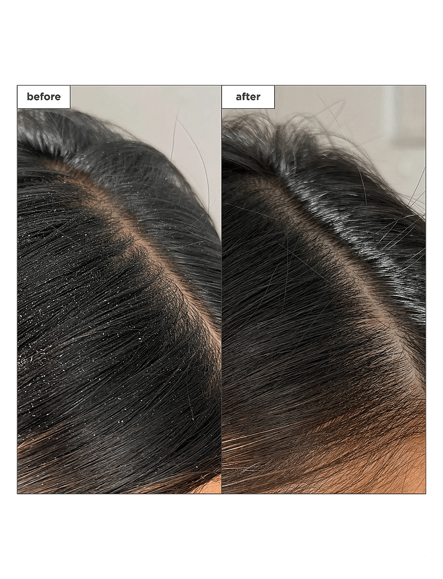 Briogeo - Briogeo Scalp Revival™ Charcoal + Tea Tree Buildup Detox Spray 120ml - hiusten tehohoidot - clear - 1