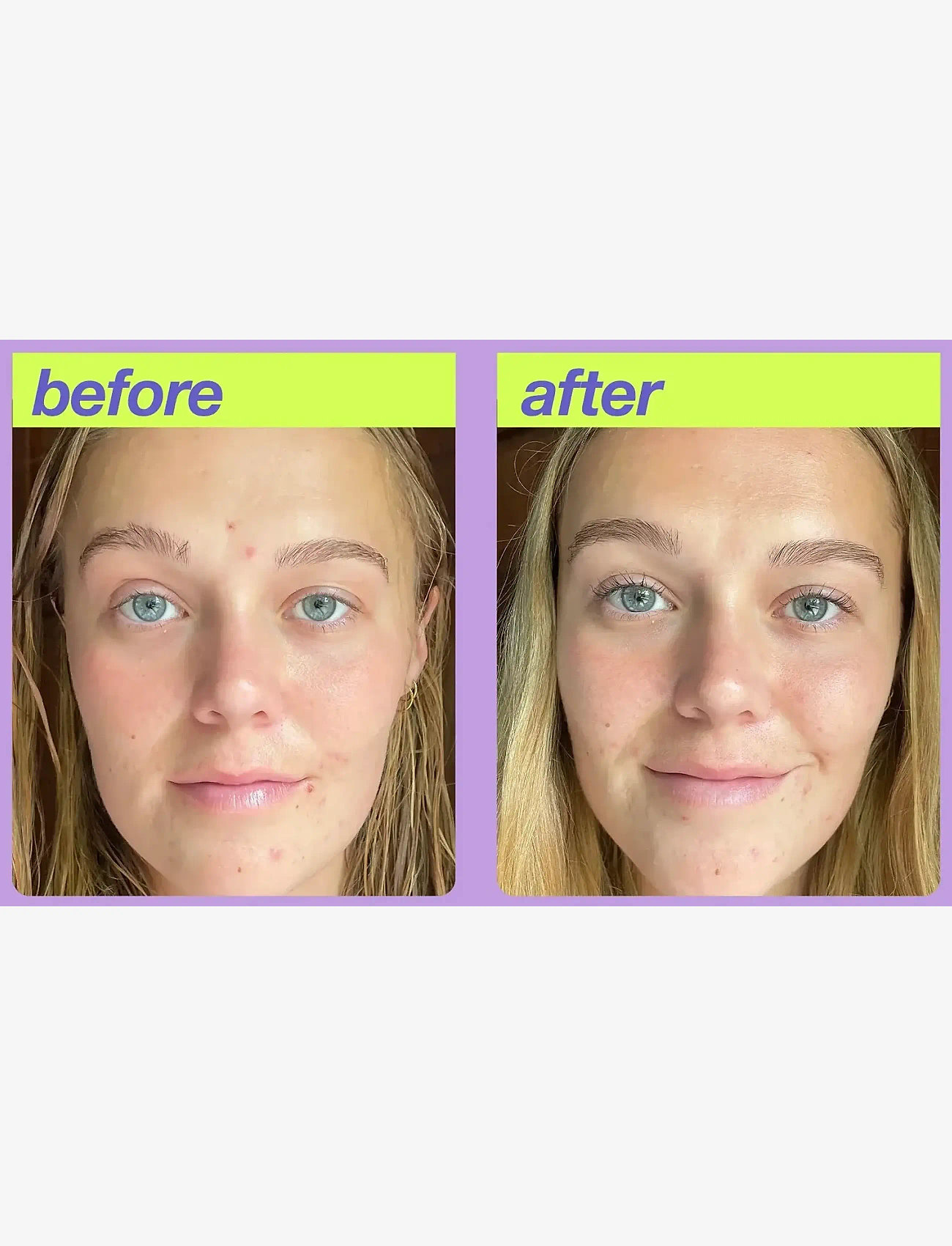 Dermalogica - Post-Breakout Fix - resestorlekar & kits - na - 2