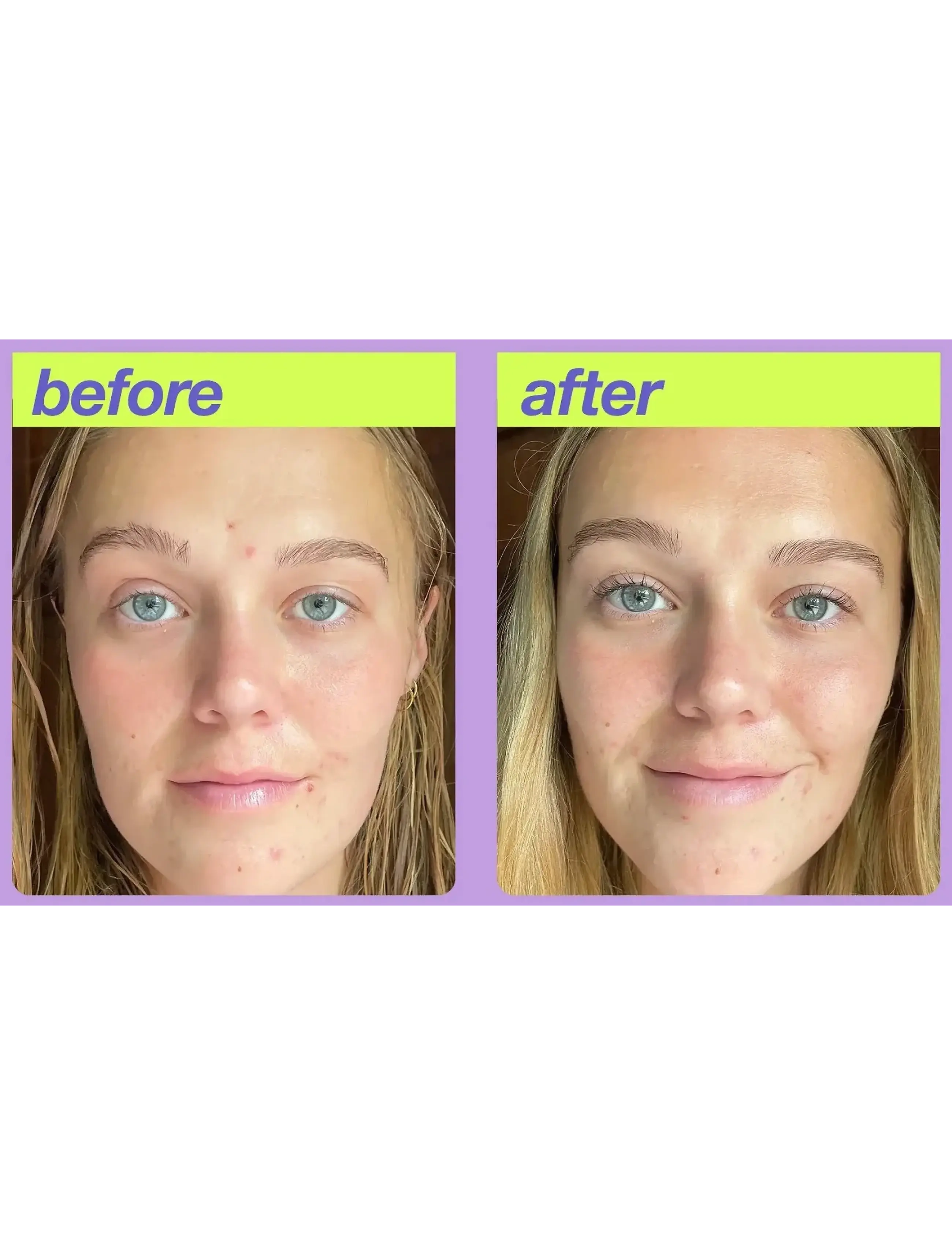 Dermalogica - Post-Breakout Fix - resestorlekar & kits - na - 2
