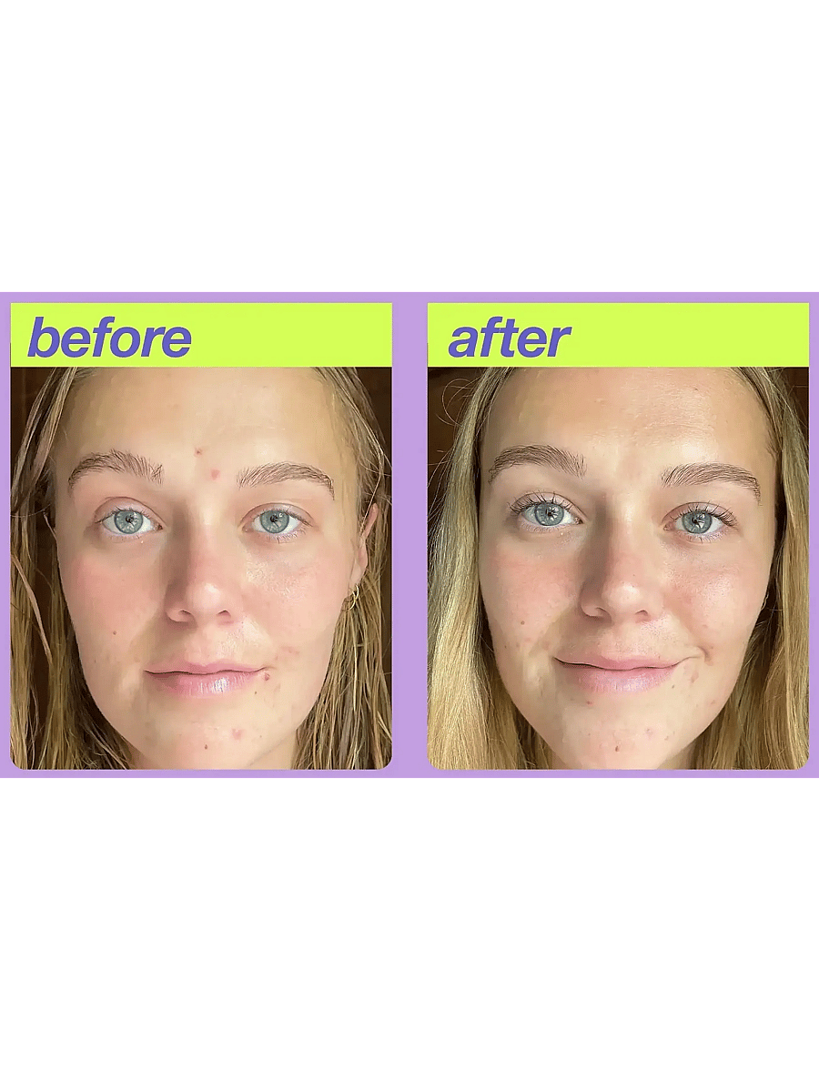 Dermalogica - Post-Breakout Fix - resestorlekar & kits - na - 2