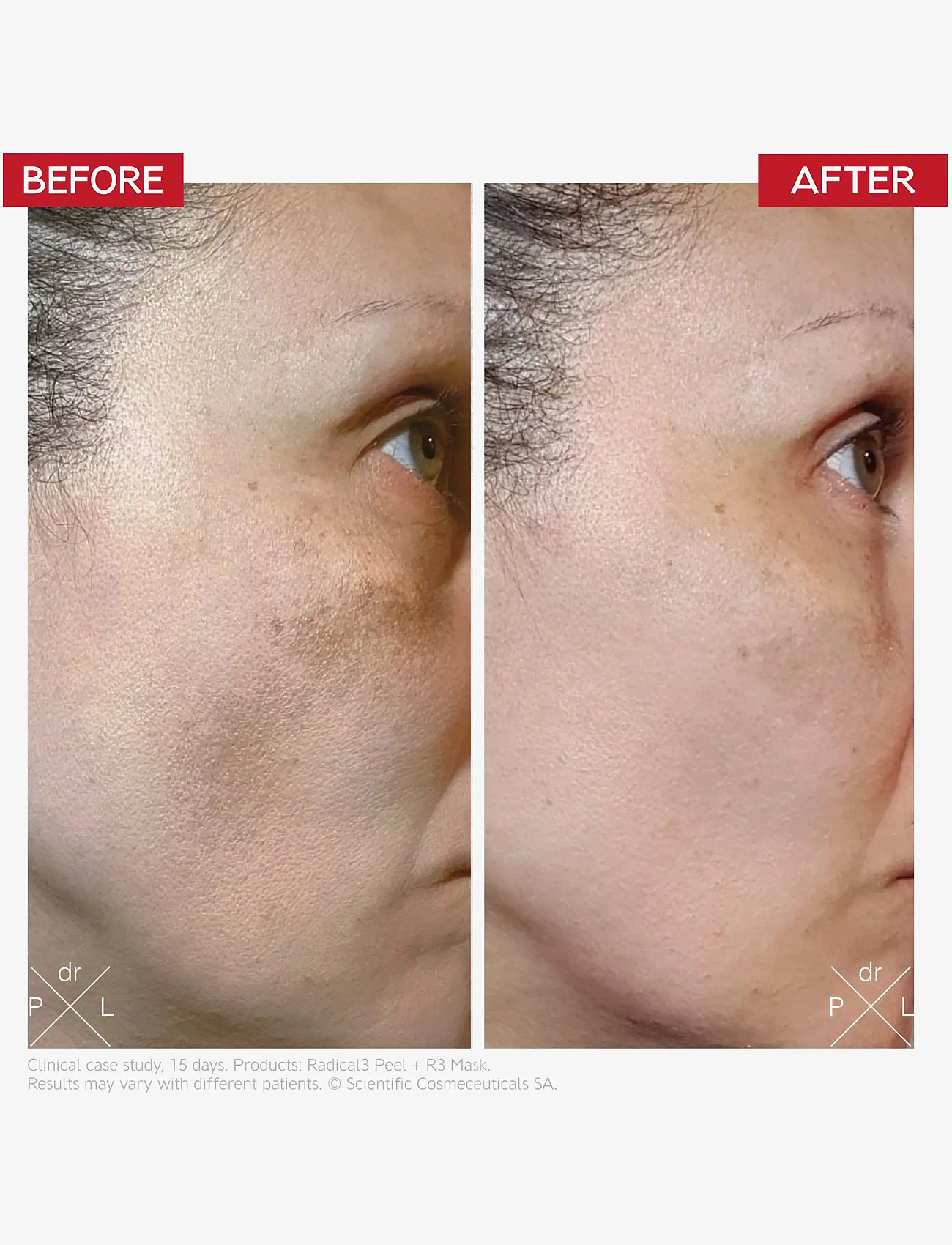 Dr. Levy - Radical3 Reboot Pro Peel - peeling - ansigte - white - 3