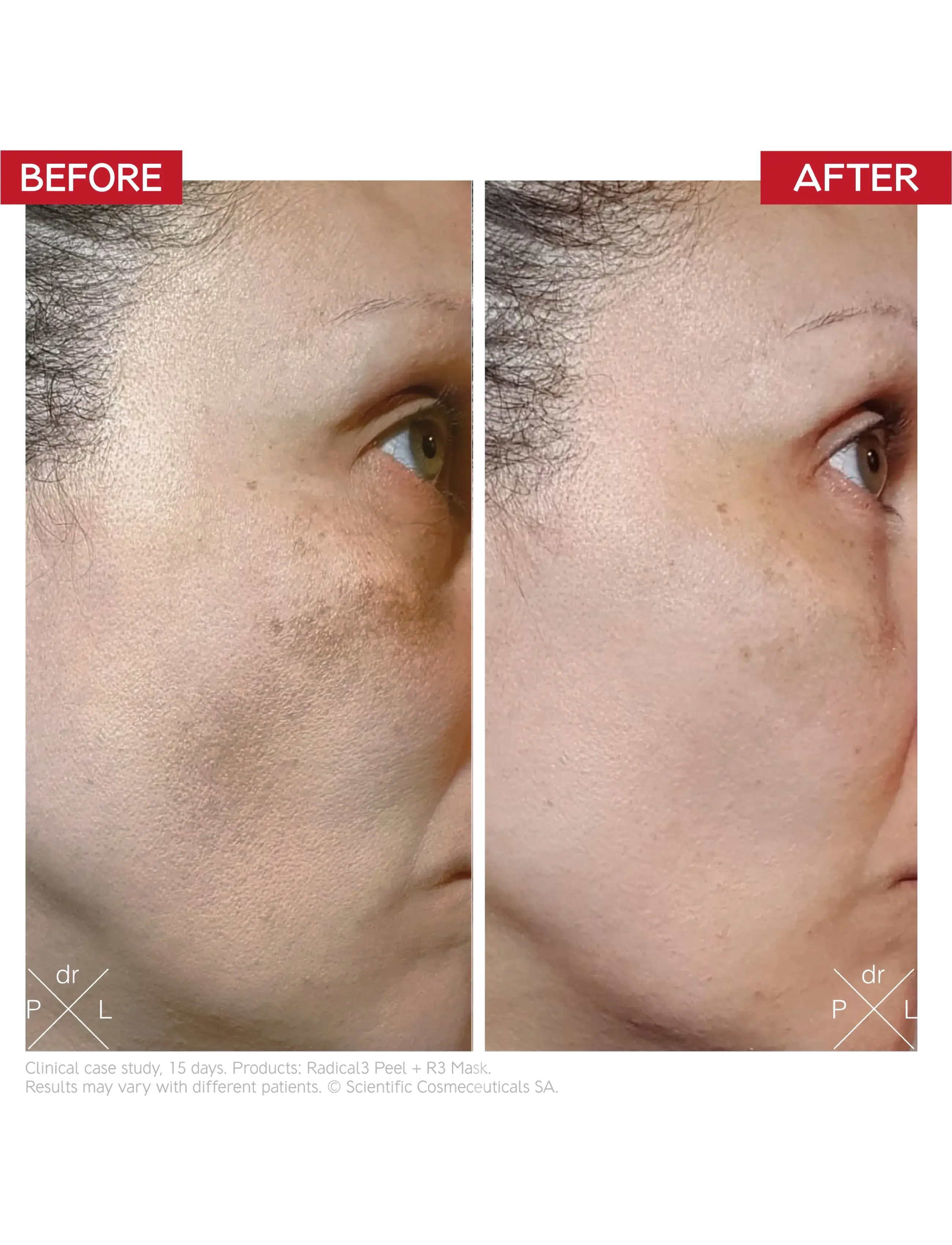 Dr. Levy - Radical3 Reboot Pro Peel - peeling - white - 3