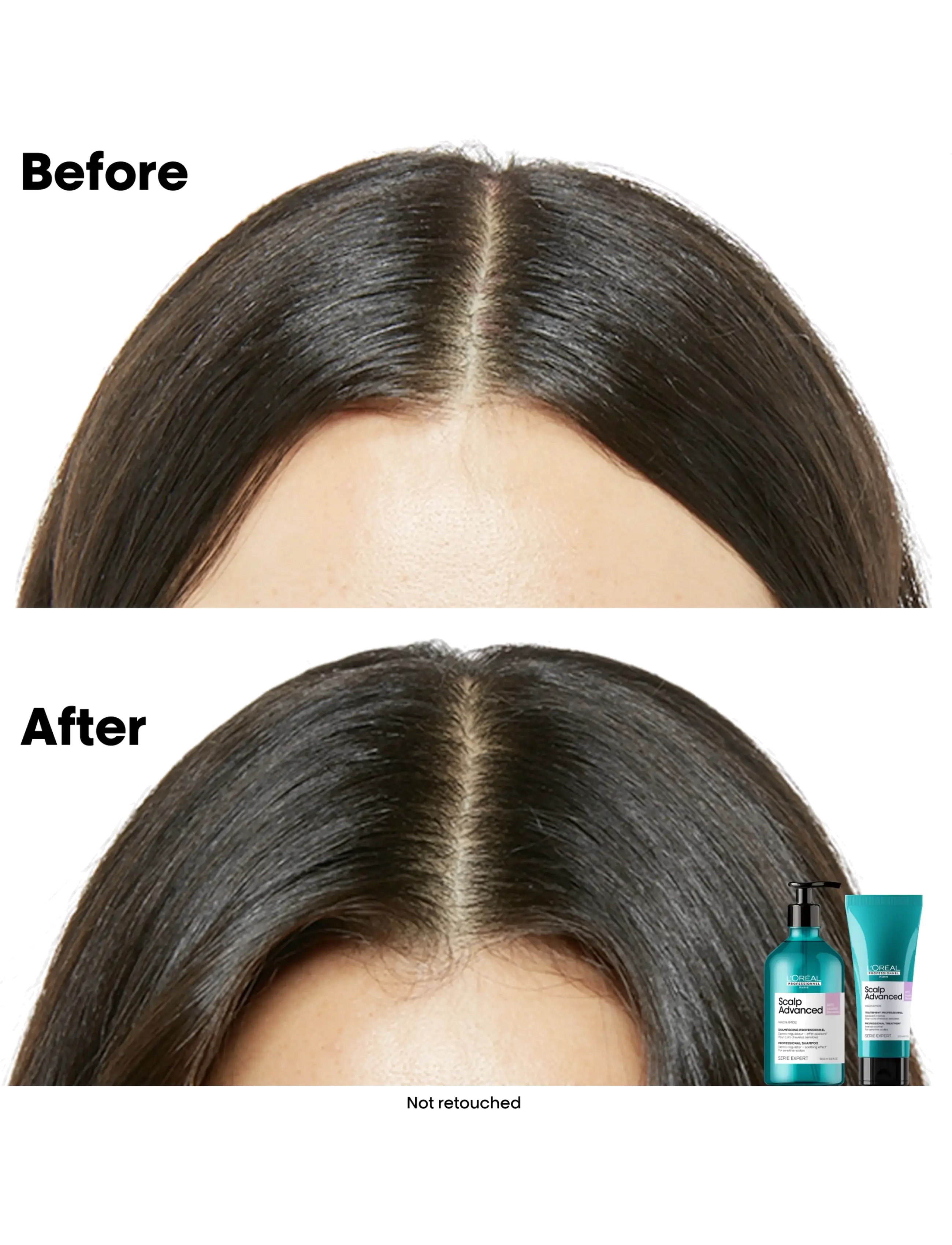 L'Oréal Professionnel - L'Oréal Professionnel Scalp Advanced Anti-Discomfort Treatment 200ml - hårkur - no colour - 1