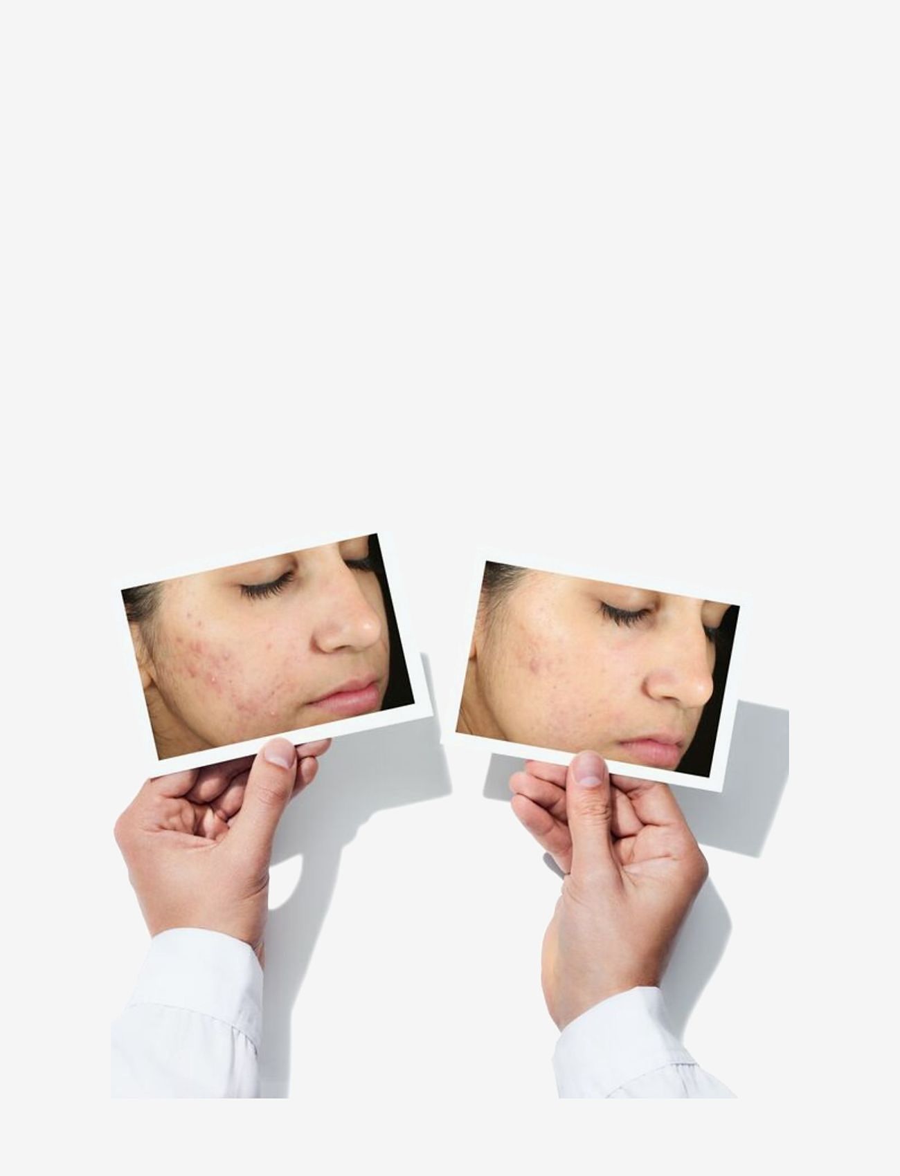 Murad - Invisiscar Blemish Scar Treatment - skincare - no colour - 3