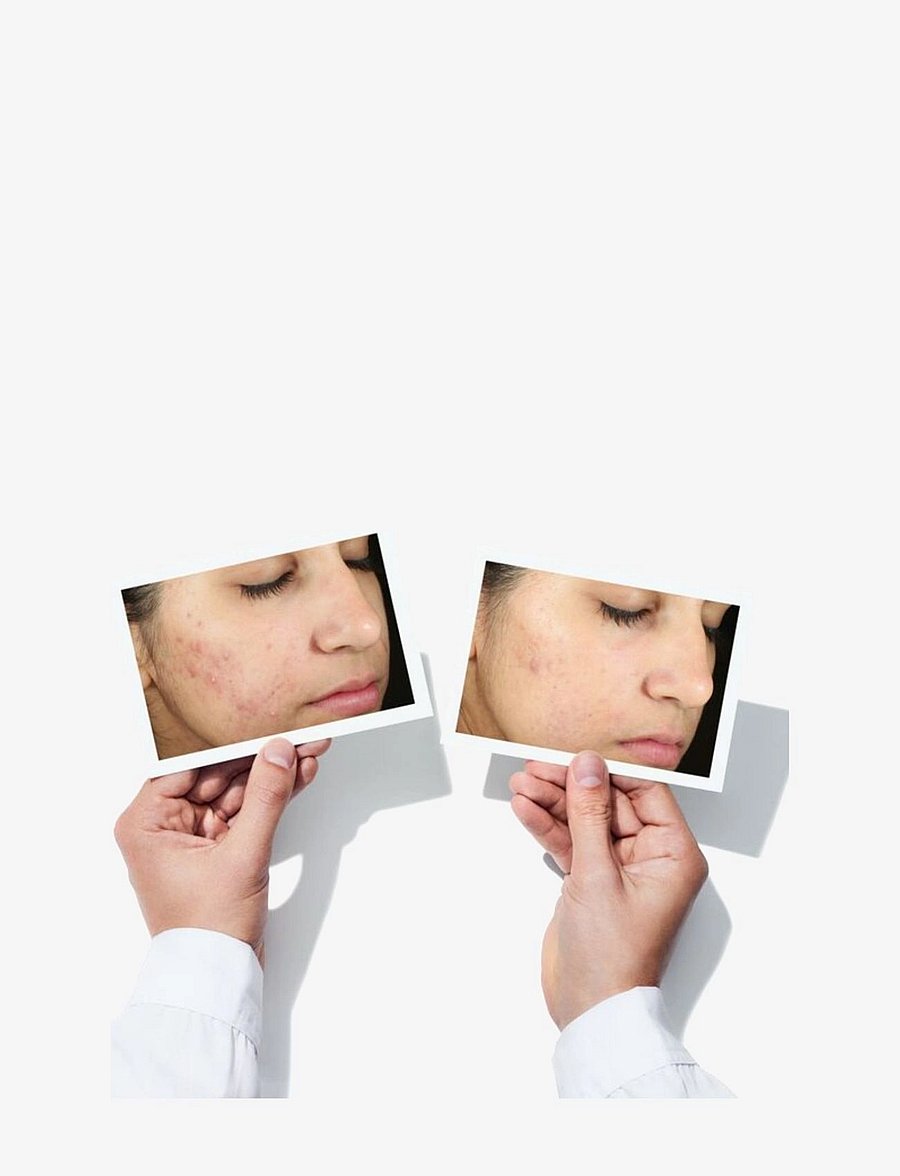 Murad - Invisiscar Blemish Scar Treatment - nahahooldus - no colour - 3