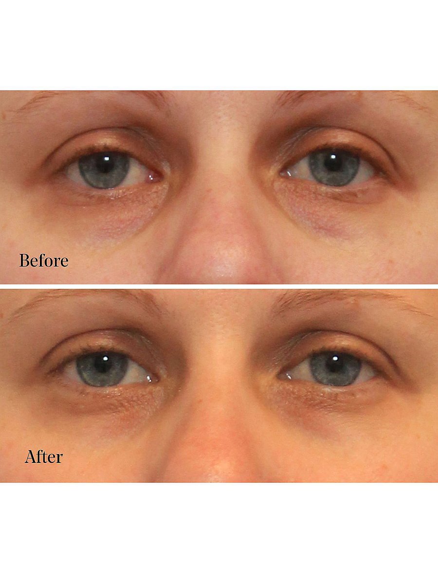 Murad - Vita-C Eyes Dark Circle Corrector - silmakreem - orance - 2