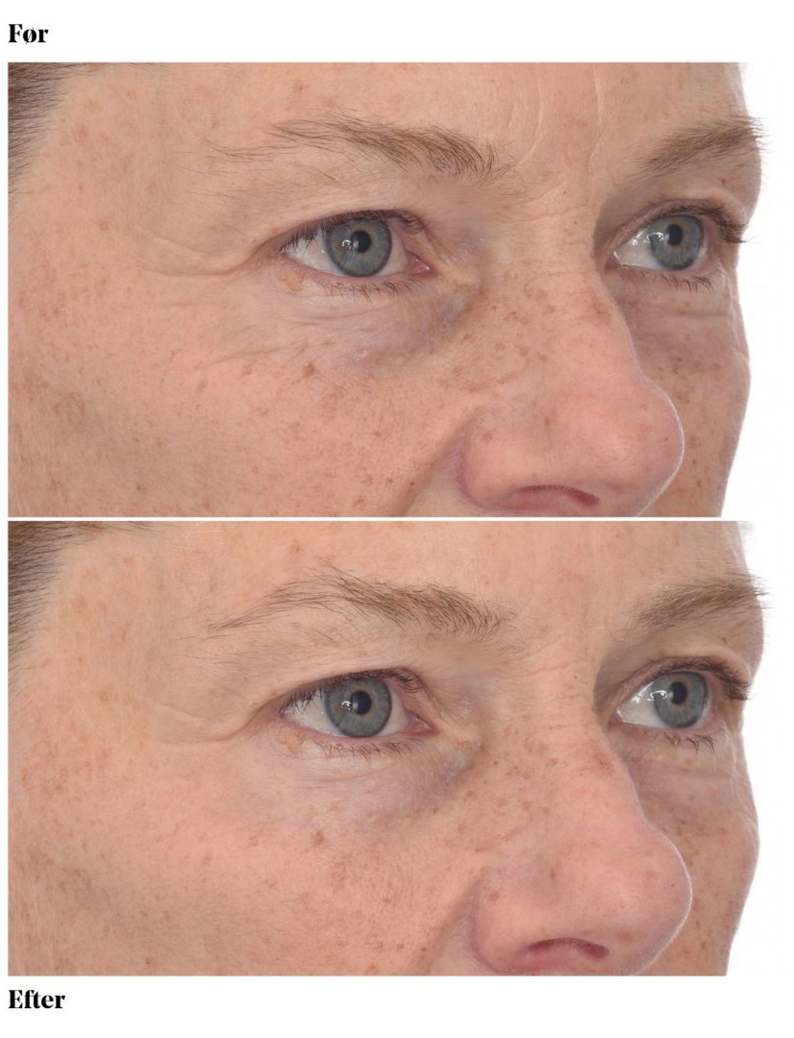 Murad - Retinol Youth Renewal Eye Masks - augnplástrar - clear - 4