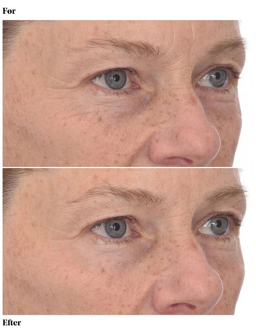 Murad - Retinol Youth Renewal Eye Masks - silmaplaastrid - clear - 4