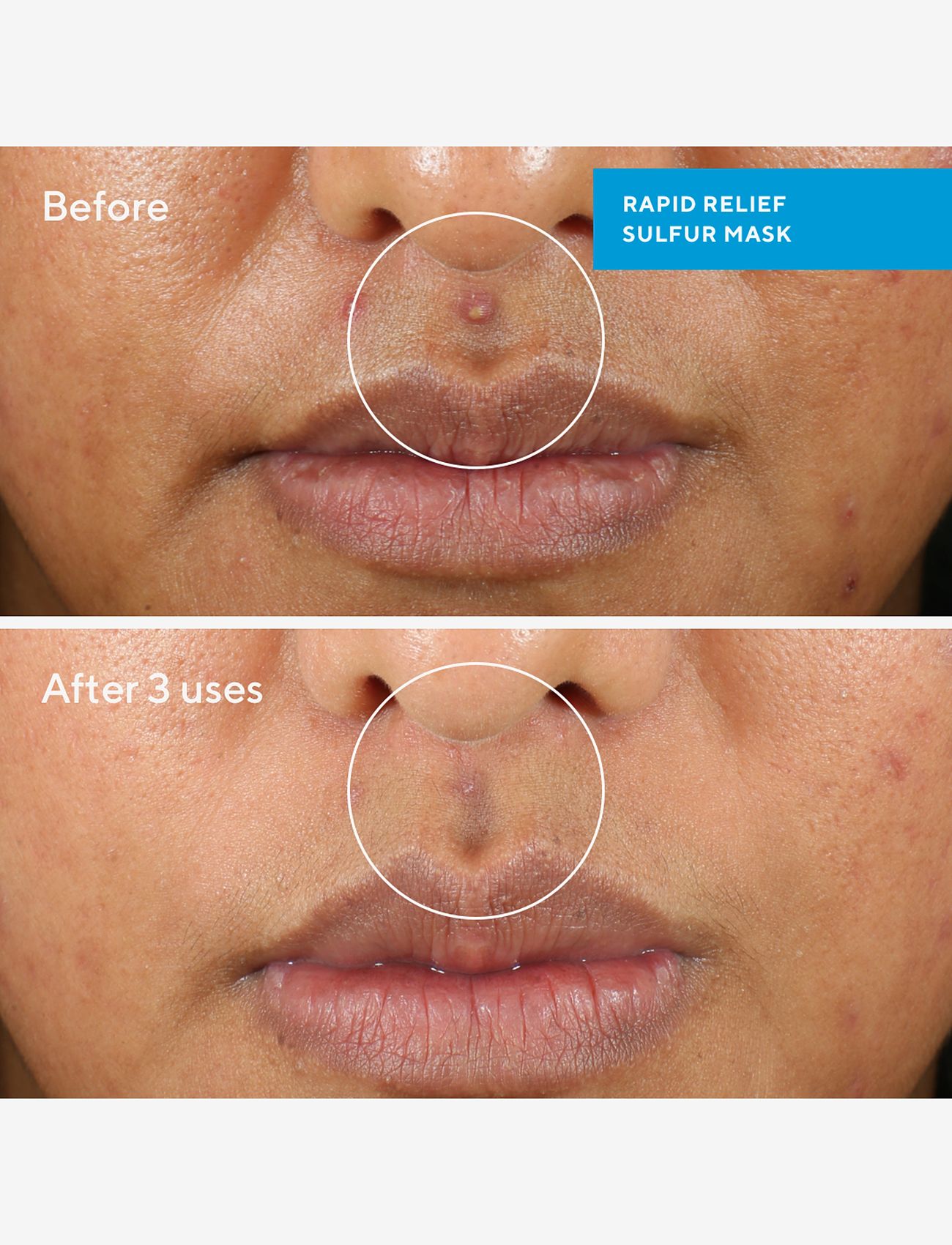 Murad - RAPID RELIEF SULFUR MASK 75 ML - spotbehandlinger - clear - 2