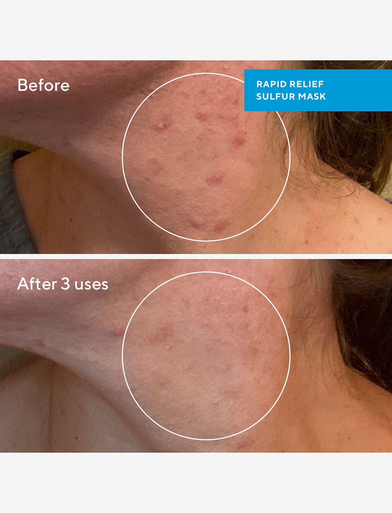 Murad - RAPID RELIEF SULFUR MASK 75 ML - spotbehandlinger - clear - 3