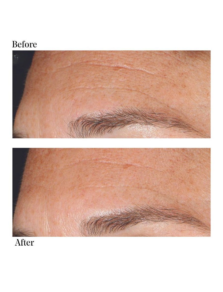 Murad - Replenishing Multi-Acid Peel - näo koorimine - clear - 3