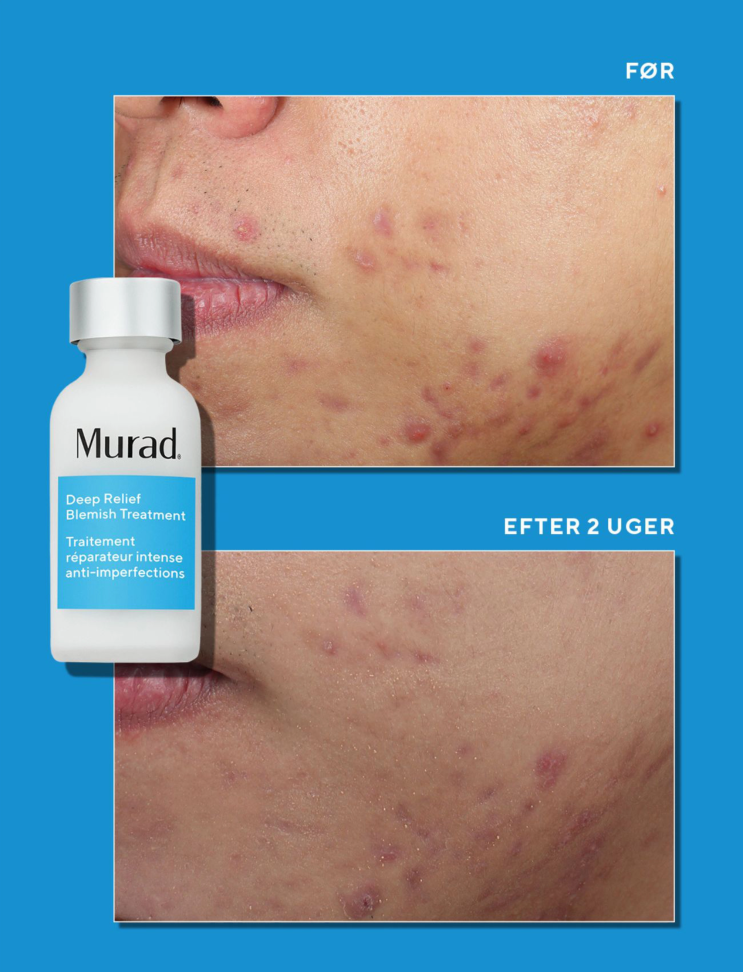 Murad - Deep Relief Blemish Treatment - laveste priser - clear - 4