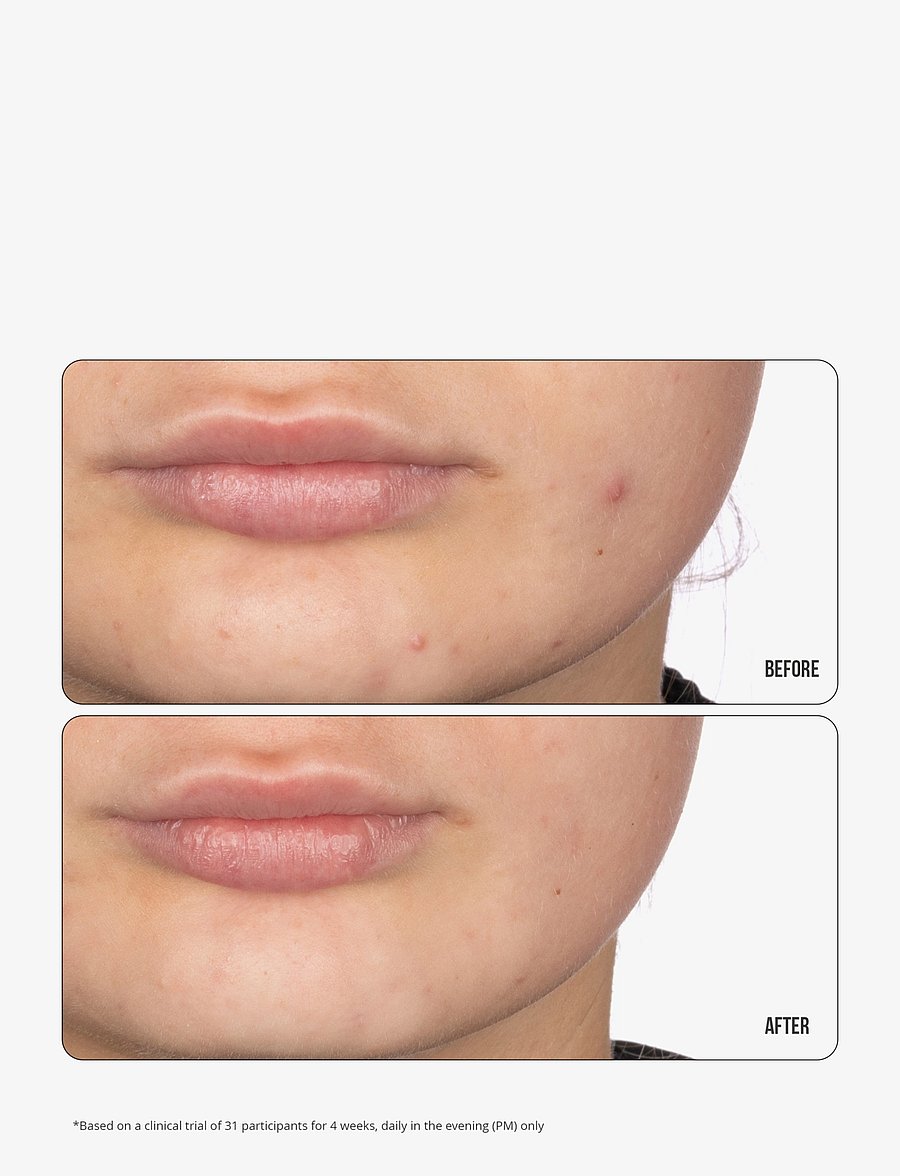 Nip+Fab - Retinol Fix Blemish Gel 15ml - ihonhoito - no color - 1