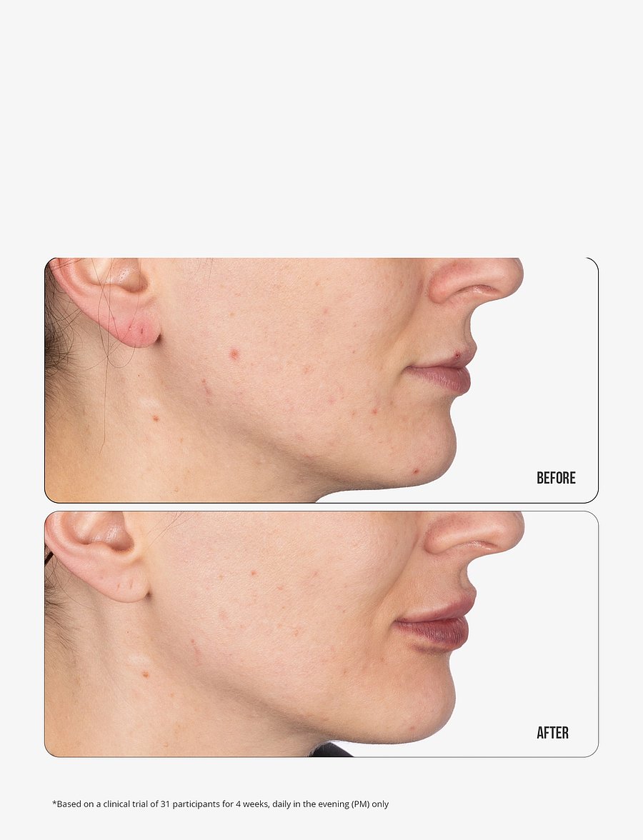 Nip+Fab - Retinol Fix Blemish Gel 15ml - ihonhoito - no color - 2