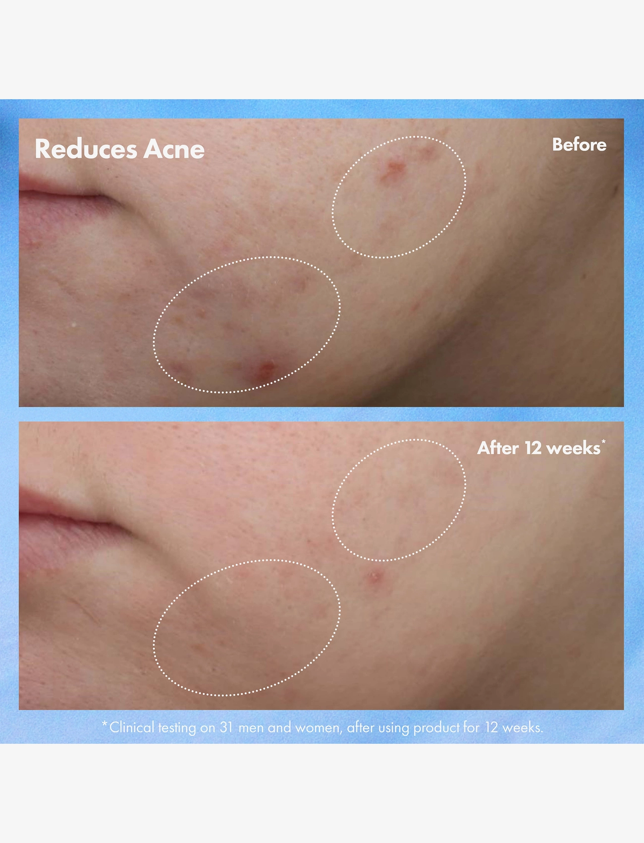 Origins - Clear Improvement Acne & Blackhead Clearing Hydrating Moisturizer Lotion - fuktpleie - multi - 2