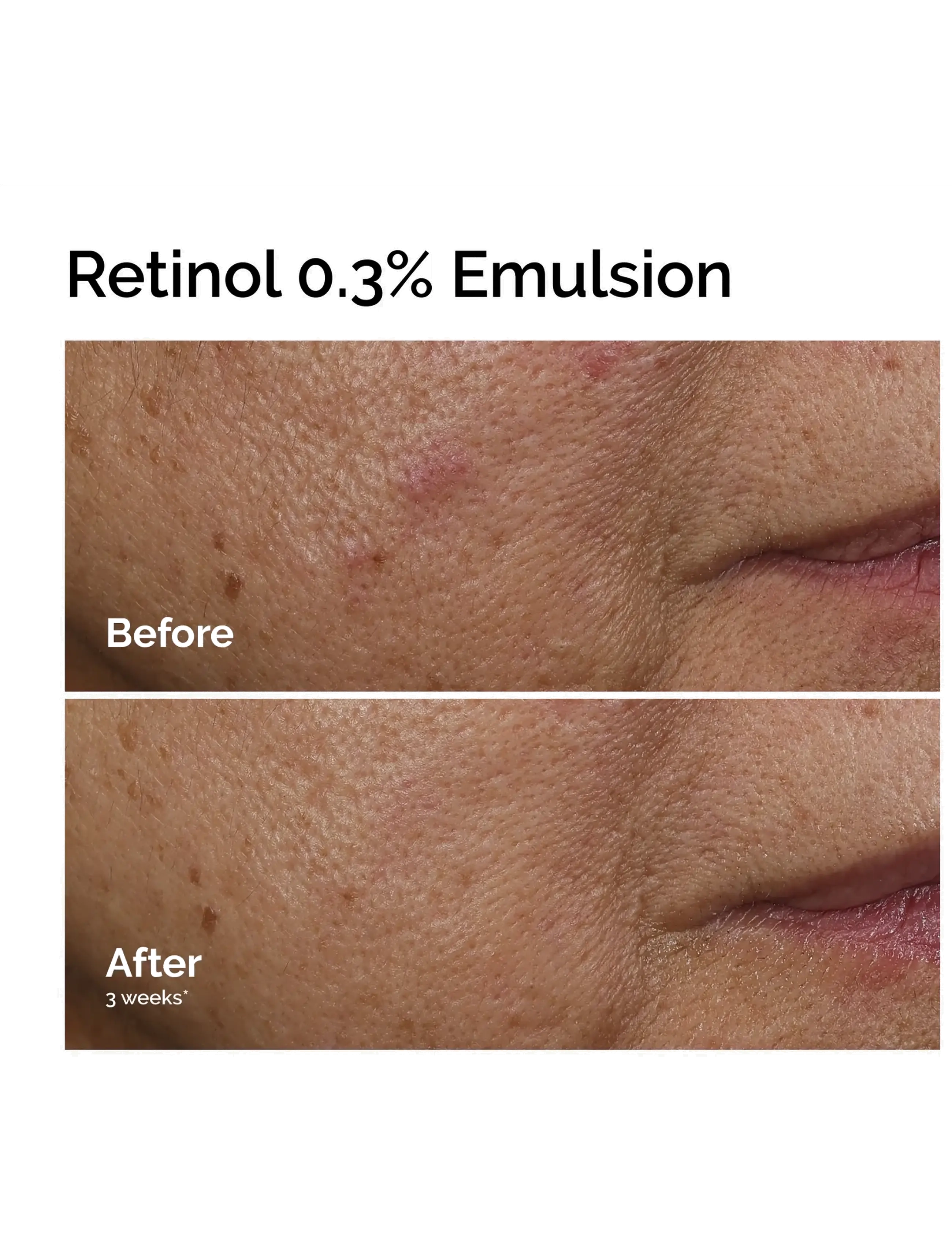 The Ordinary - Retinol 0.3% Emulsion - serum & oljor  - no color - 5